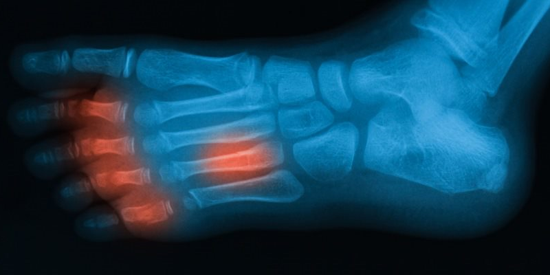 X-ray of a foot